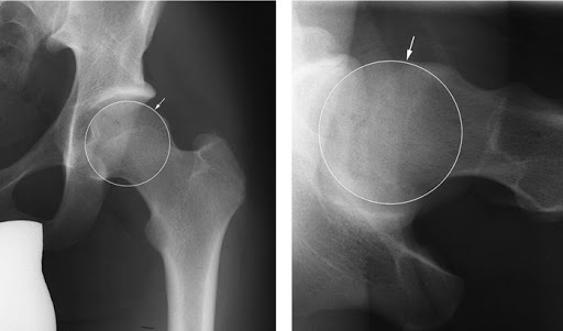 Hip joint impingement syndrome. Symptoms, signs, treatment