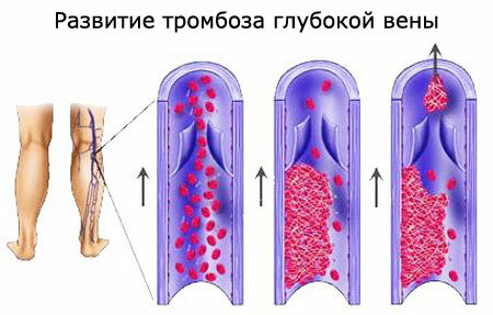 Globoka venska tromboza spodnjih okončin, simptomov in zdravljenja