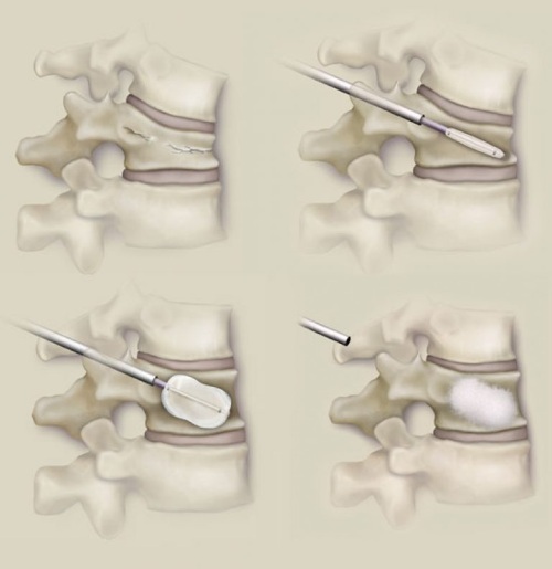 Fracture of the cervical vertebra. Consequences, symptoms, treatment