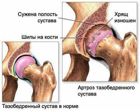 Osteoartrite da articulação do quadril