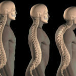 Kyphosis av thoracic ryggrad