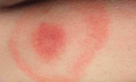 Lyme sygdom foto