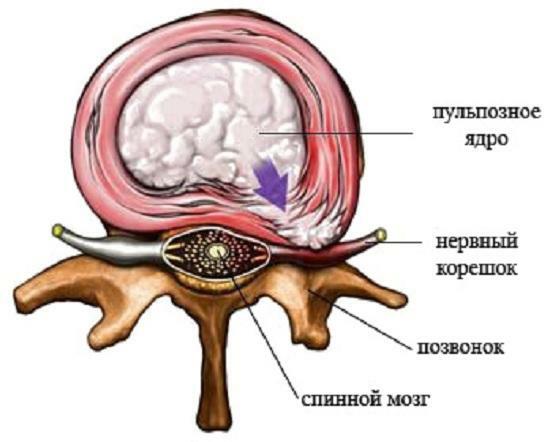 Localizarea rădăcinilor spinării