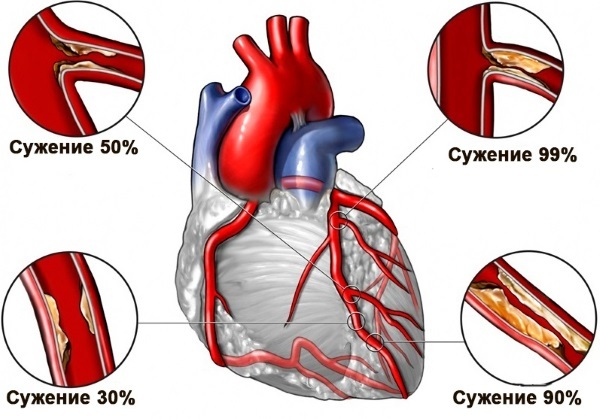 Ventricular premature beats. What it is, treatment, what is dangerous, causes, ECG, drugs