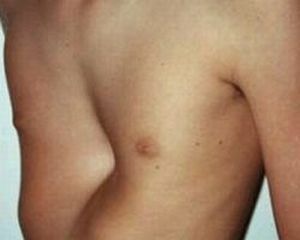 Why do children have a deformity of the chest