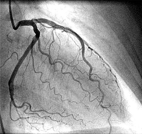 Dilated cardiomyopathy. What is it, symptoms, treatment in adults, children