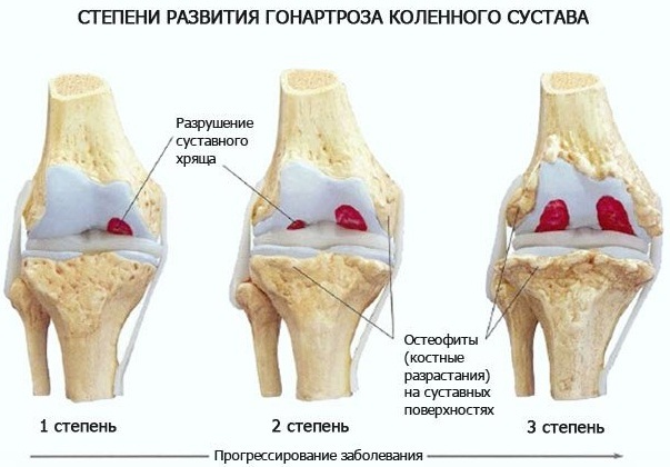 Osteoarthritis of the knee joint of 1 degree. Treatment of folk remedies and medicines