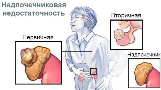 Cum doare glandele suprarenale. Simptome și tratament la femei