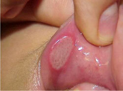 The first signs of syphilis