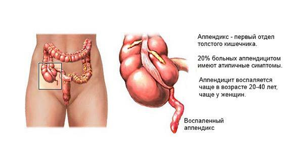 Manifestarea apendicitei