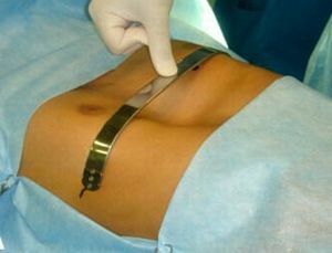 treatment of chest deformities