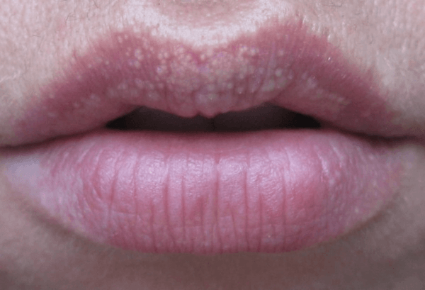 Papules on the lips