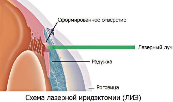 Laser iridectomy. What is it, indications, postoperative period, restrictions, price