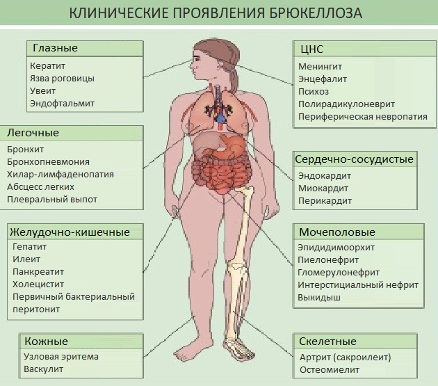 Brucellosis in humans. Symptoms, causative agent, routes of infection, diagnosis, treatment, clinical guidelines
