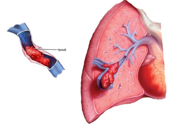 Pulmonary embolism. Symptoms, signs, diagnosis, treatment