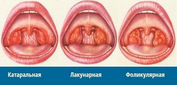 Tipos de dor de garganta