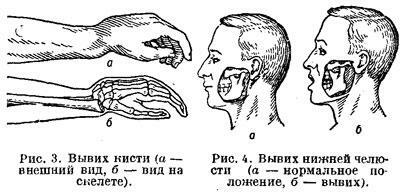 Dislocazione della mano e dislocazione della mascella inferiore