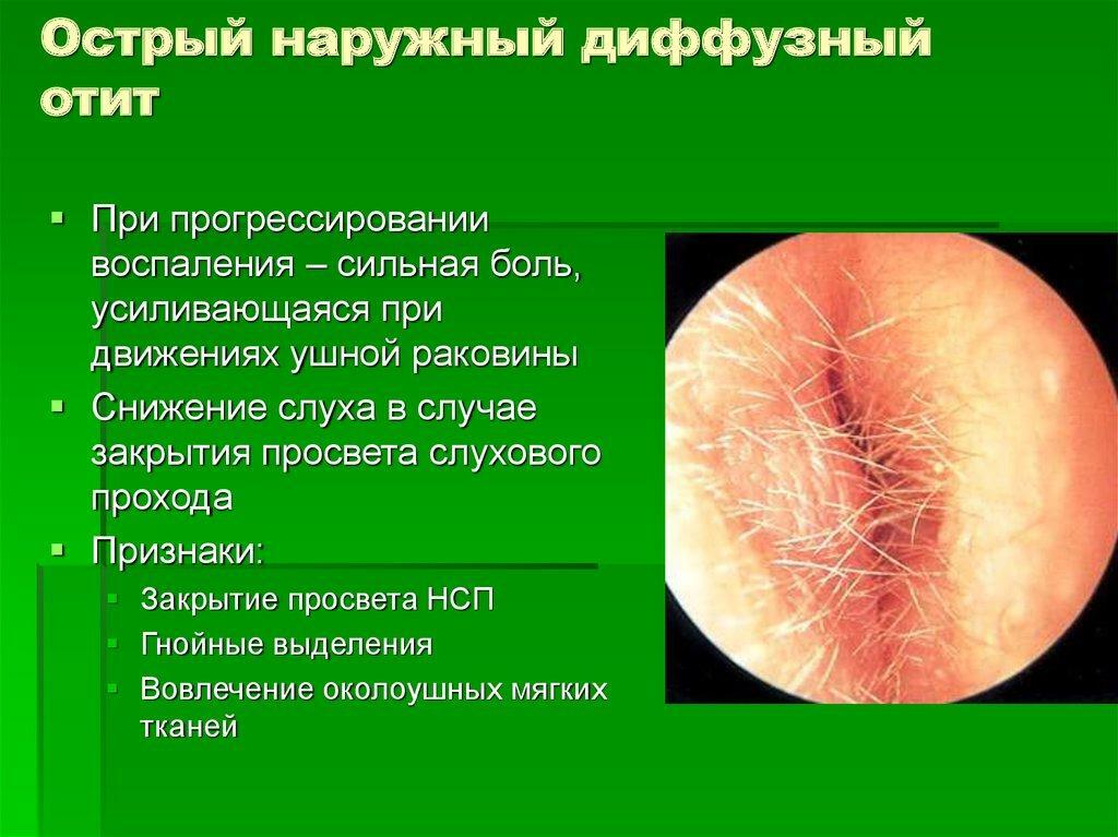 Symptoms of diffuse otitis