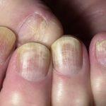 White or yellowish-gray tint of nails
