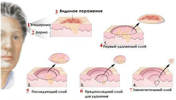 Electrocoagulation of moles