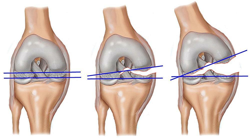 Лечение разрыва мениска коленного. Разрыв мениска и крестообразной связки. Крестообразные связки коленного сустава разрыв 1 степени. Разрыв связок ПКС коленного сустава. Разрыв связок и повреждение мениска.