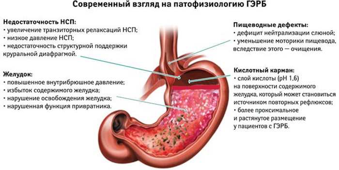 GERD (gastroesofageal reflux). Symptom och behandling, kost