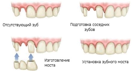 Klasifikasi cacat gigi menurut Kennedy. Ortopedi