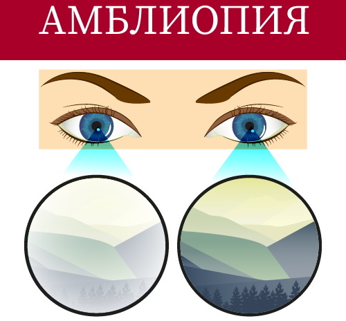 Lusta szem (amblyopia) gyermekeknél. Okok és kezelés