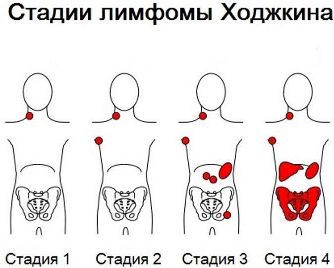 Hodgkin's disease (nodular sclerosis). What is this disease, blood test, pathogenesis in children, adults, clinical guidelines