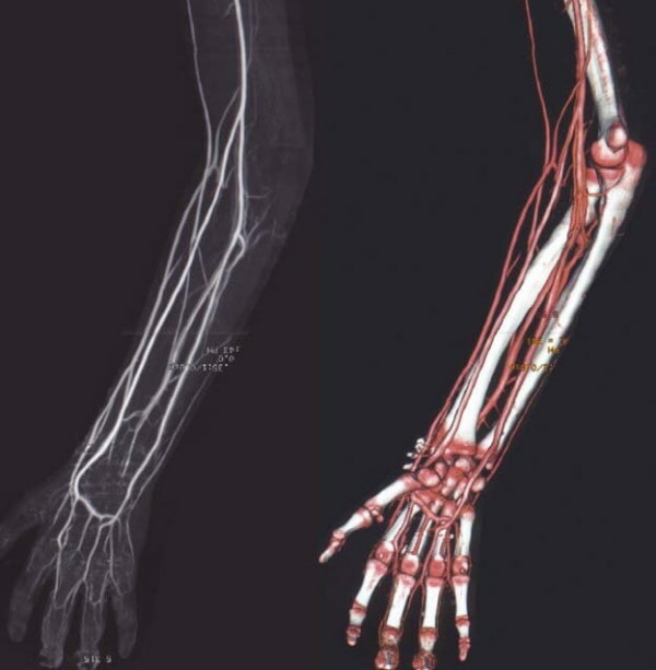 Viršutinės galūnės arterijos. Anatomija, diagrama, lentelė, topografija
