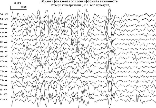 Bagaimana dan mengapa aktivitas epilepsi muncul di EEG
