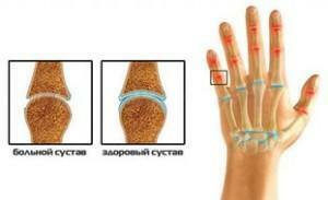 Esquema de articulações de artrite saudáveis ​​e afetadas