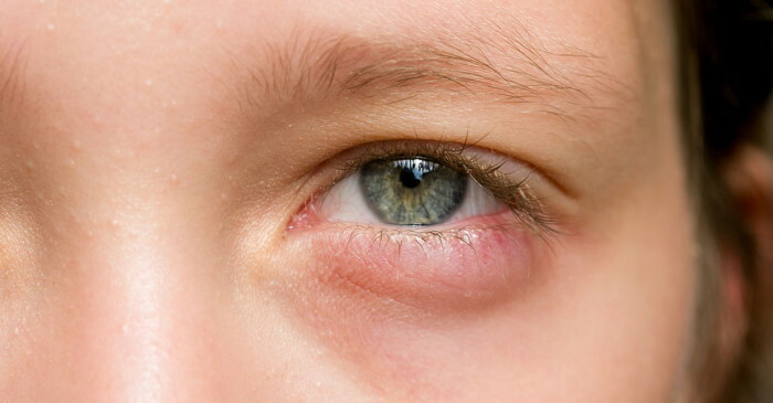Det nedre øyelokket er hovent og barnets øye gjør vondt