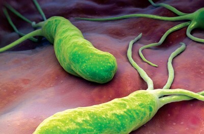 Gastrita( gastroduodenita), erozivă, cronică - codul micro-10