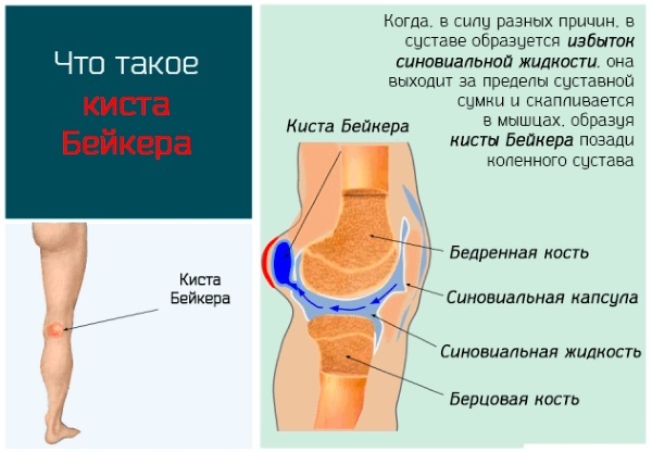 Smerter i knæet side på indersiden, det ydre, ydre, fra og til låret. Årsager og behandling. Hvortil lægen bede