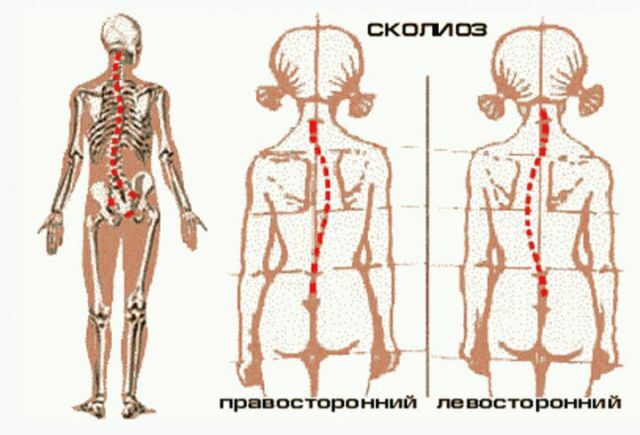 Scolioticna drža - še ni skolioza, vendar ni več norma