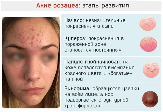 Rash on the forehead of women. Causes, photo, allergy medication during pregnancy