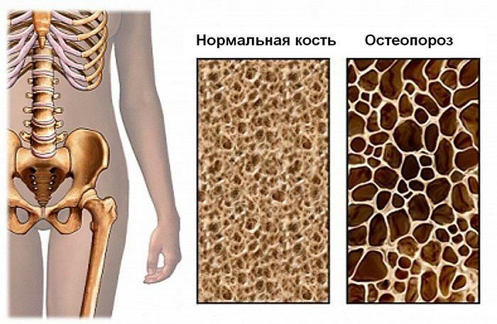 Difuzní osteoporóza