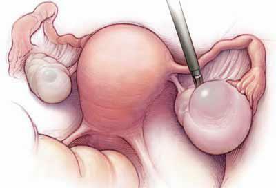 Surgical treatment of cysts