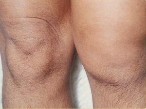 Oticanje koljena