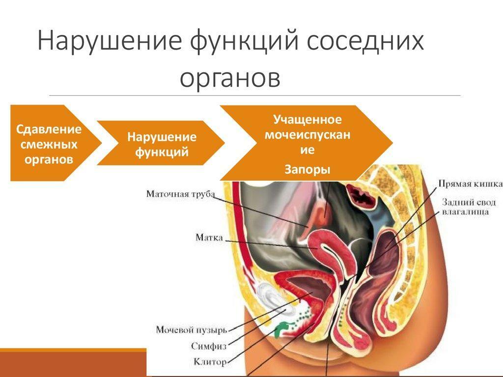 Verletzung der Funktionen benachbarter Organe mit Myomen des Uterus