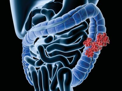 Semne ale cancerului( tumorii) intestinului la femei, bărbați: cum se verifică pentru oncologie