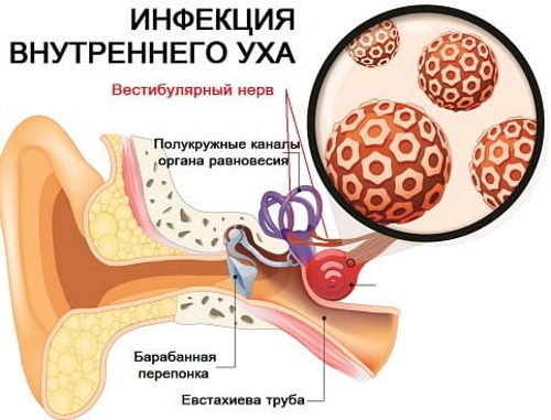 Neuronitis vestibular. Síntomas y tratamiento, ejercicio.