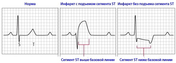 Como ler você mesmo o eletrocardiograma do coração. Decodificação de ECG
