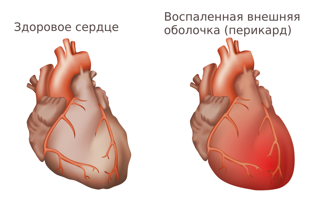 קרום הלב מודלק