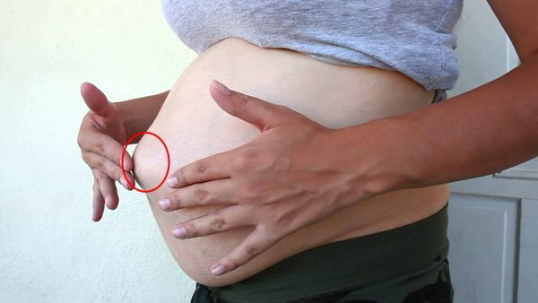 Clicks in the abdomen during early, late pregnancy