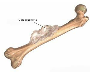 Ostéolyse: quand les os se dissolvent d'eux-mêmes