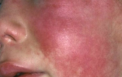Scarlet fever in children: photos, symptoms and treatment, prevention