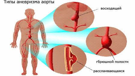 Tipuri de anevrism aortic