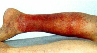 Zmiernenie aterosklerózy ciev dolných končatín: liečba, symptómy, prevencia